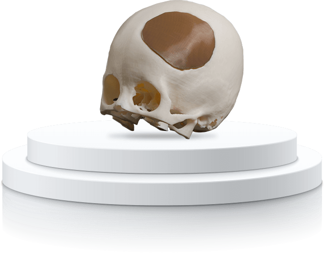 唐都病院における骨腫瘍切除手術および3DプリントPEEK頭蓋インプラント